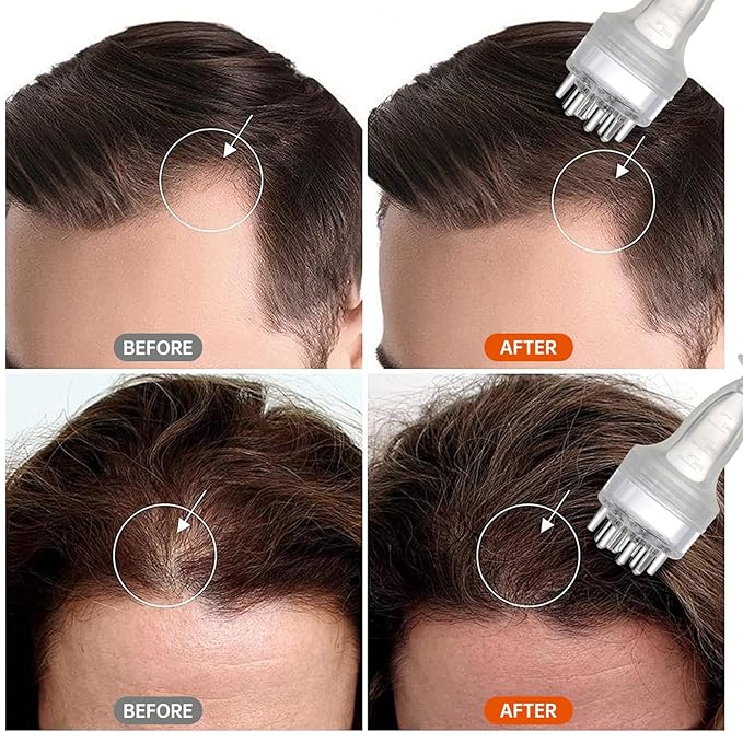 Minoxidil Applicator, Scalp Oil Applicator - Transparent easy to Observe, Easy to Clean, Controlled Flow Rate - Ideal for Minoxidiland & Wild Growth Hair Oil